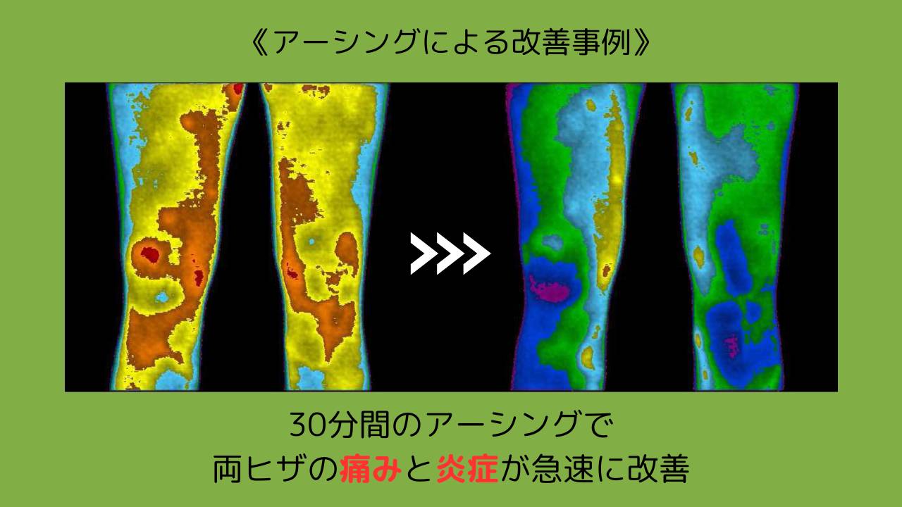 アーシングによる改善事例…ヒザ